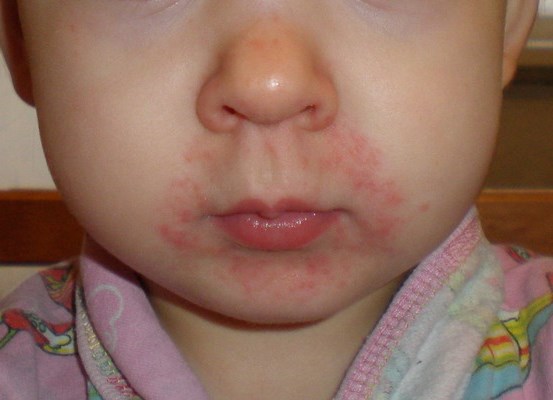 Аллергия- чувствительность организма к различным раздражителям