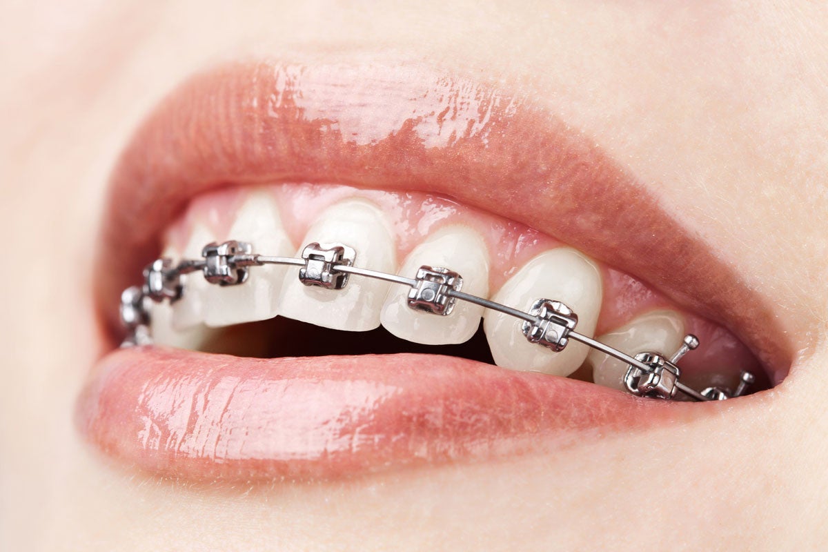 Ровные зубы вернули любовь детей: спасибо саморегулирующим брекетам