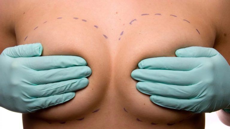 Операция по уменьшению груди: кому нужна и зачем?