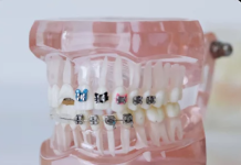 Ортодонтия для взрослых: почему никогда не поздно улучшить улыбку